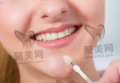 牙齿贴面改善图 牙齿贴面改善图