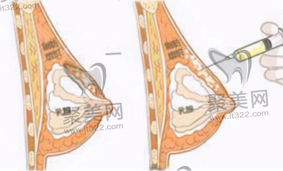 自体脂肪丰胸费用 自体脂肪丰胸费用