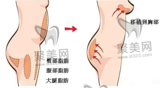 自体脂肪丰胸好不好 自体脂肪丰胸好不好
