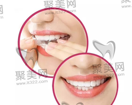 隐形矫正 隐形矫正