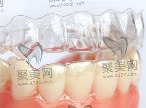 隐形矫正 隐形矫正