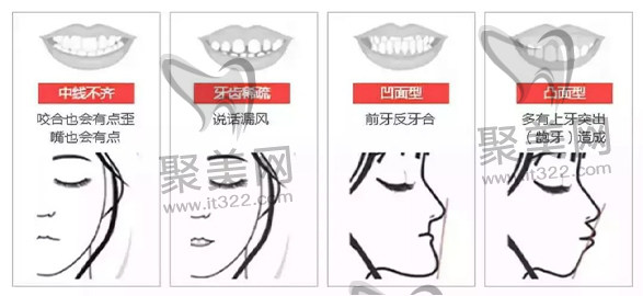 牙齿畸形分类 牙齿畸形分类