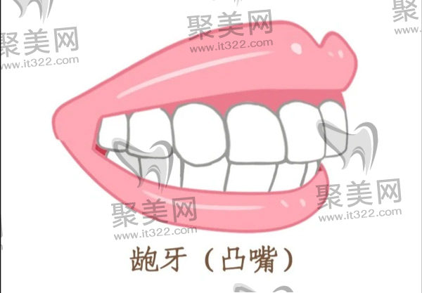 40岁龅牙还有必要矫正吗? 40岁龅牙还有必要矫正吗?