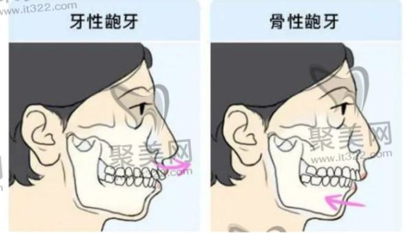 牙性or骨性 牙性or骨性