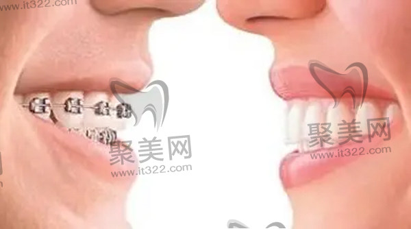 传统金属托槽 传统金属托槽