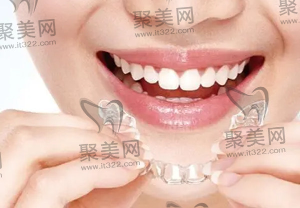 隐形矫正 隐形矫正