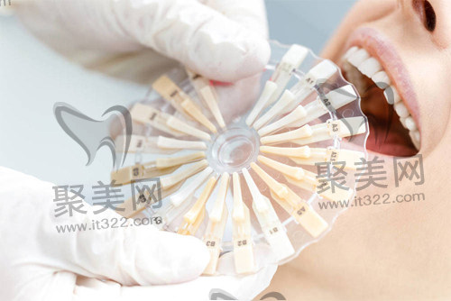 美加瓷贴面 美加瓷贴面