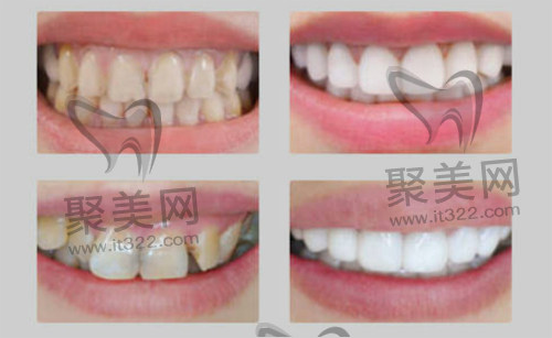 美加瓷贴面 美加瓷贴面