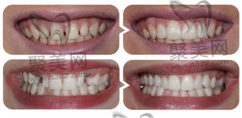 不同价格的全瓷牙有什么区别 不同价格的全瓷牙有什么区别