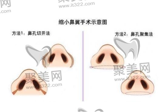 缩小鼻翼鼻头手术多少钱? 缩小鼻翼鼻头手术多少钱?