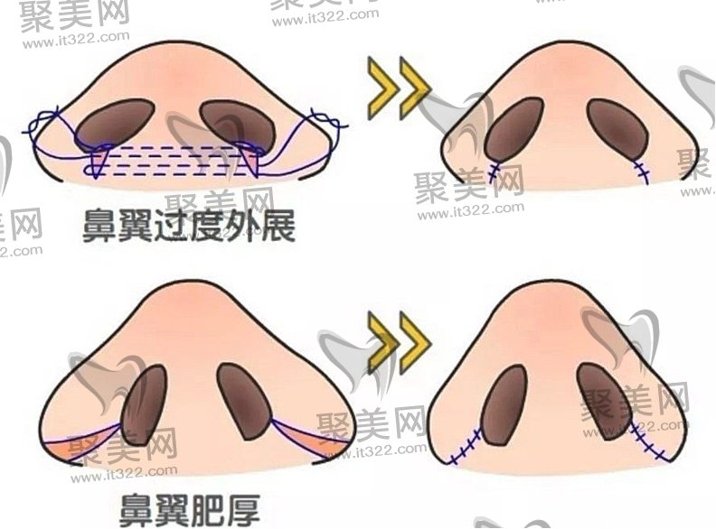 缩小鼻翼鼻头手术后有哪些可能的后遗症? 缩小鼻翼鼻头手术后有哪些可能的后遗症?