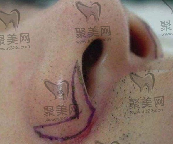 鼻翼缩小有风险吗 鼻翼缩小有风险吗