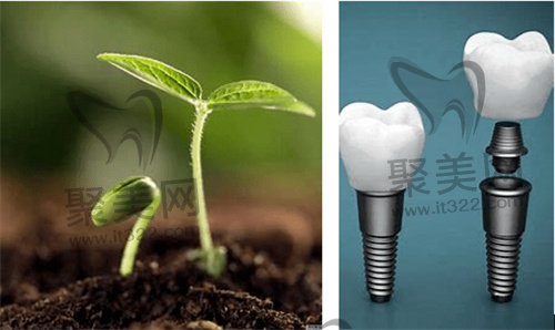 种植牙 种植牙