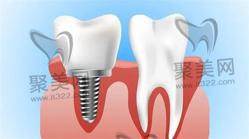 种植牙 种植牙