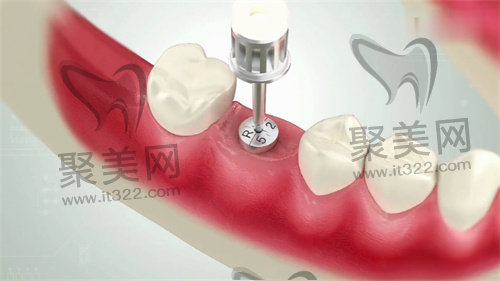 种植牙 种植牙