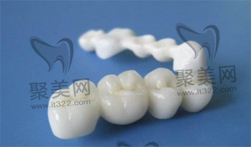 烤瓷牙 烤瓷牙