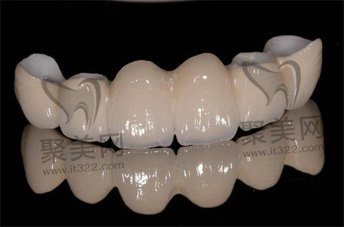 烤瓷牙 烤瓷牙