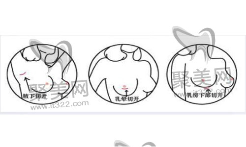 假体隆胸 假体隆胸