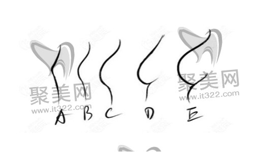 假体隆胸 假体隆胸