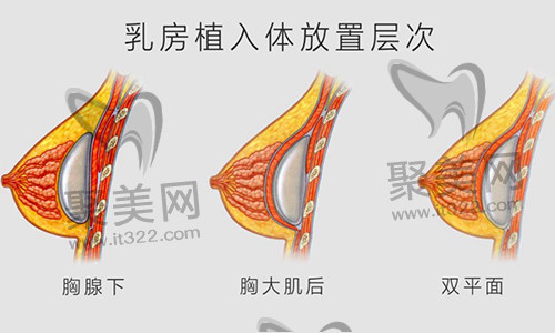 假体隆胸 假体隆胸