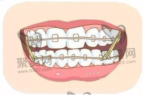 牙齿矫正 牙齿矫正