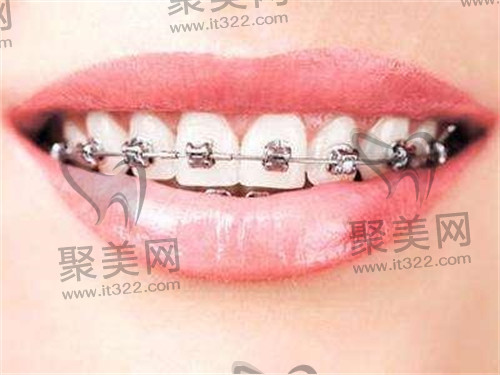 牙齿矫正 牙齿矫正