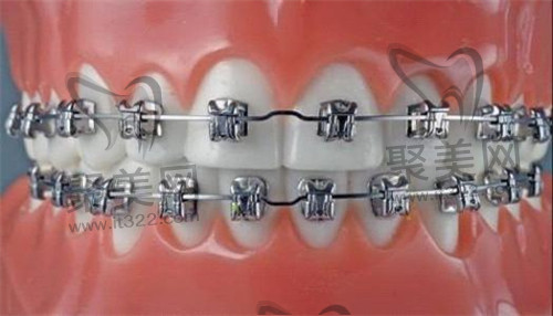牙齿矫正 牙齿矫正