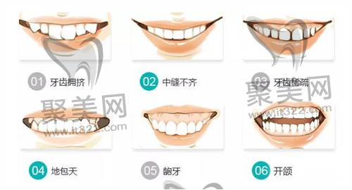 牙齿矫正 牙齿矫正