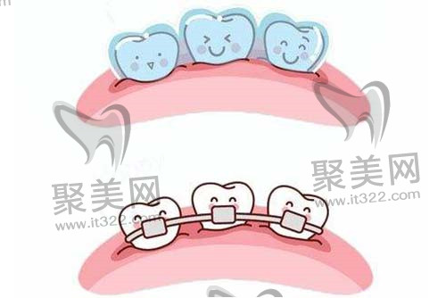 牙齿矫正 牙齿矫正