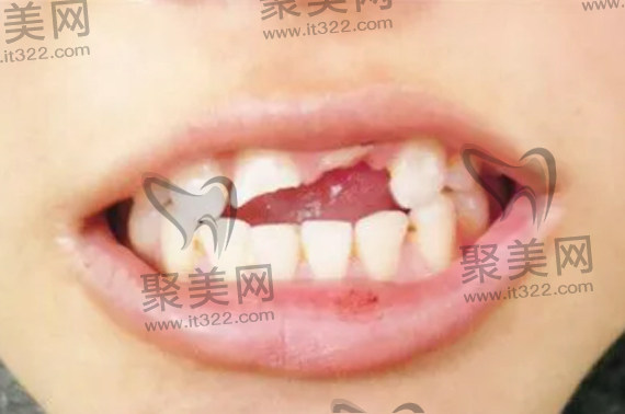 门牙断了一半还能长出来吗 门牙断了一半还能长出来吗