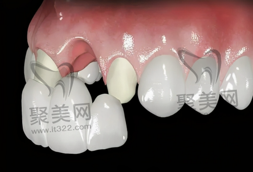 烤瓷牙和全瓷牙怎么选 烤瓷牙和全瓷牙怎么选