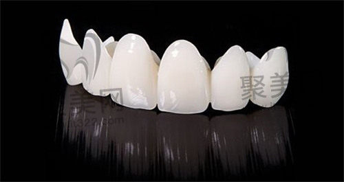 全瓷牙 全瓷牙