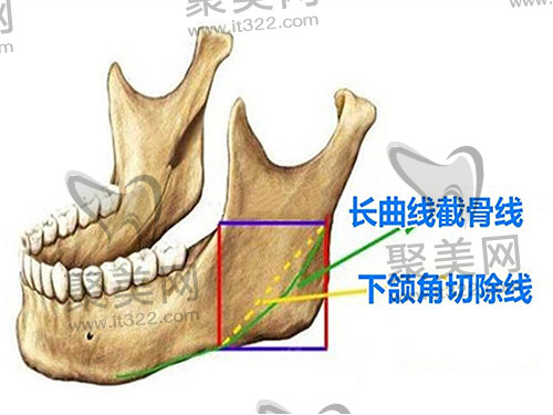 广州广大做下颌角怎么样 广州广大做下颌角怎么样