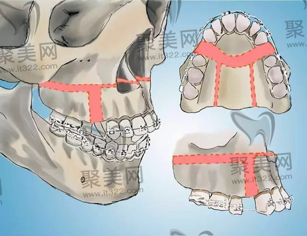 何锦泉正颌手术技术好 何锦泉正颌手术技术好