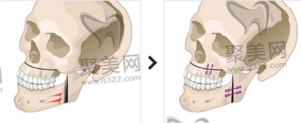 广大何锦泉做正颌手术 广大何锦泉做正颌手术