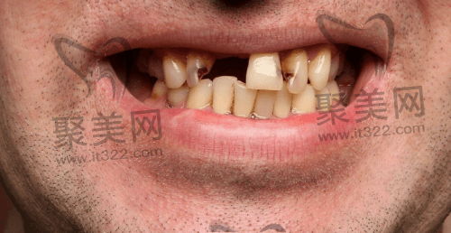 48岁缺牙种牙好还是镶牙好 48岁缺牙种牙好还是镶牙好