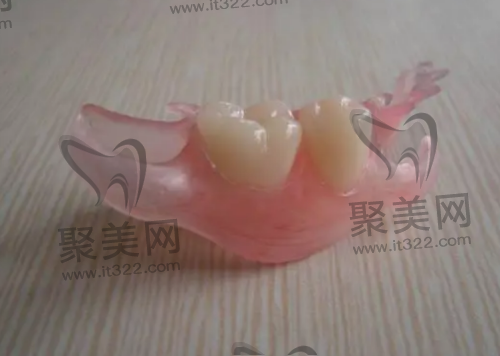 活动义齿 活动义齿