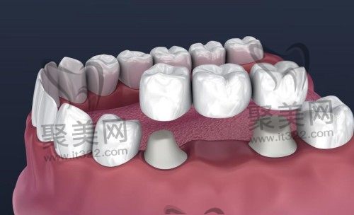 固定义齿 固定义齿