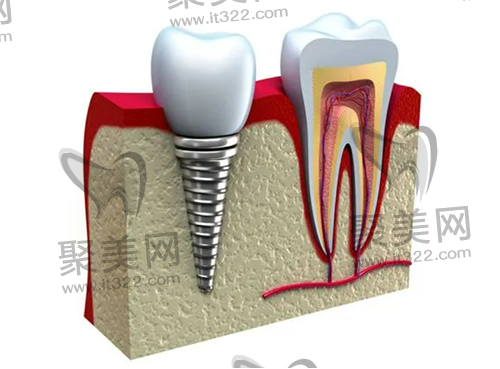 种植牙的使用年限 种植牙的使用年限