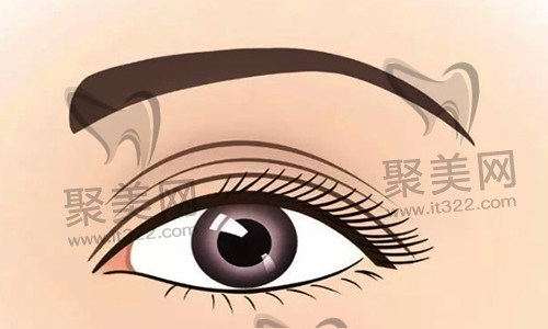 双眼皮修复