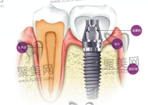 种植牙 种植牙