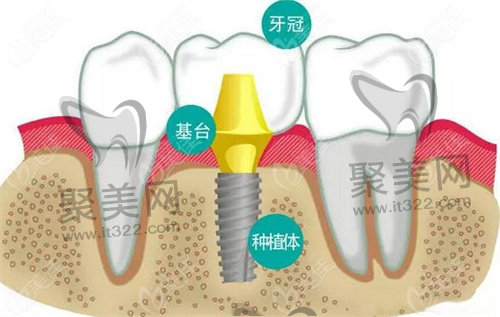 种植牙 种植牙