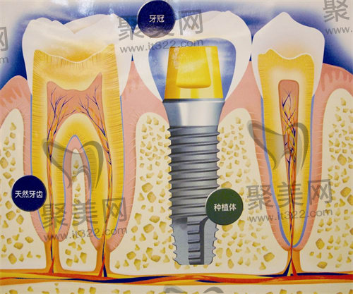 种植牙 种植牙