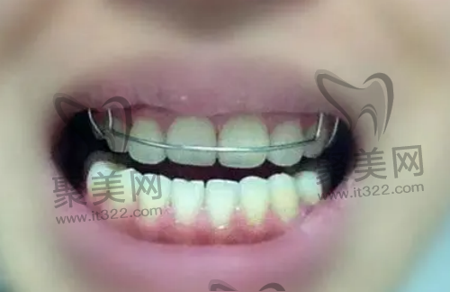矫正结束戴保持器 矫正结束戴保持器