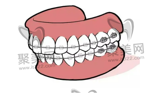 牙齿矫正 牙齿矫正