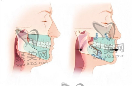正颌手术 正颌手术