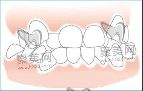 正颌手术 正颌手术