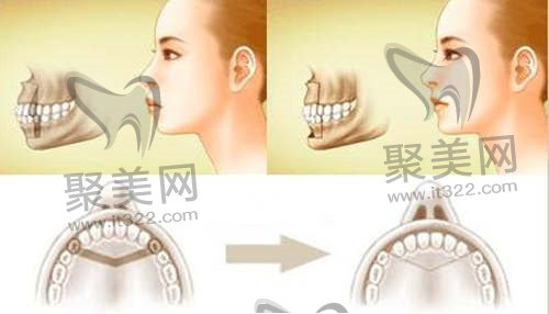 正颌手术 正颌手术