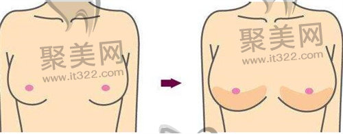 胶原蛋白丰胸 胶原蛋白丰胸