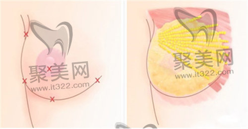 胶原蛋白丰胸 胶原蛋白丰胸